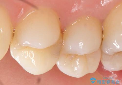 X線撮影によりわかる、内在する虫歯治療の治療前