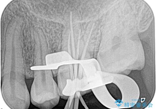 奥歯が痛い。根管治療の治療後