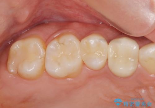 以前治療した歯が痛む　銀歯をセラミックにの症例 治療後