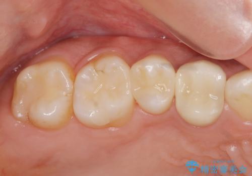 以前治療した歯が痛む　銀歯をセラミックにの治療後