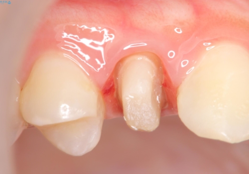 虫歯で歯が折れた セラミック審美修復の治療中