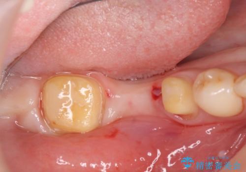 インプラントを用いた臼歯部欠損補綴の治療中