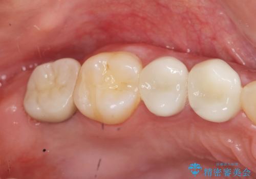 インプラントを用いた臼歯部欠損補綴の治療後