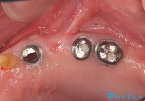 [入れ歯にしたくない] 臼歯部インプラント補綴の治療中