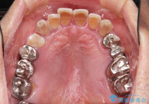 インプラントを用いた歯周病全顎治療の治療前