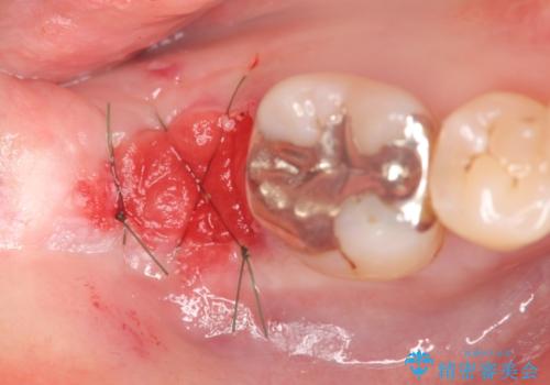 抜歯時歯槽堤保存術を用いた骨造成・インプラント治療の治療前