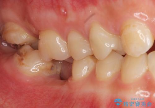 インプラントを用いた臼歯部欠損補綴の治療前