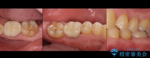 50代男性 受け口 他院で5年以上かかると治療を断られたの治療後