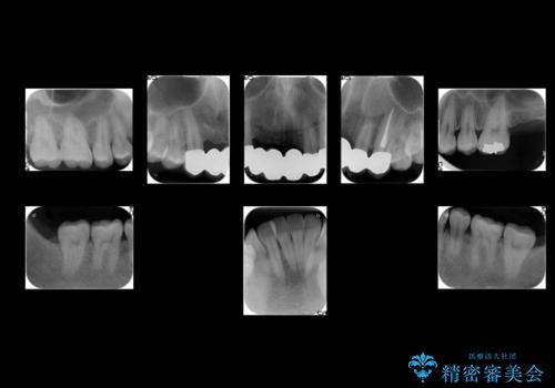 前歯ブリッジのやりかえ　下の歯のがたつき　銀歯を全てセラミックにの治療後