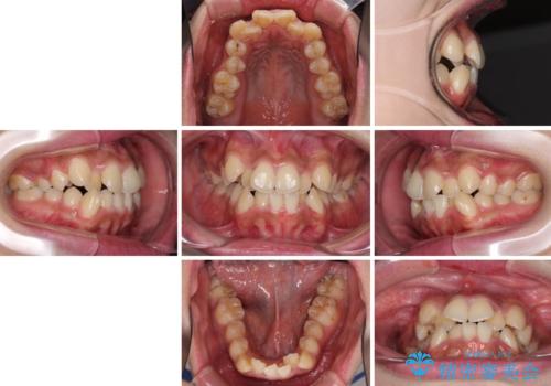 口元をスッキリと ワイヤーでの抜歯矯正の治療前