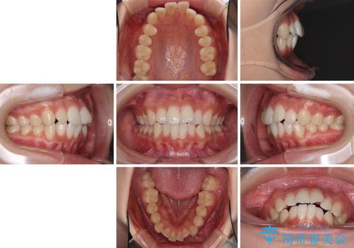 前歯のデコボコと突出感 インビザラインで改善の治療前