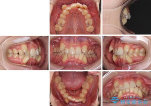 気になる八重歯を治したい ワイヤー装置での抜歯矯正の治療前