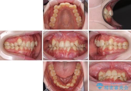 前歯をきれいに整えたい ワイヤー装置での非抜歯矯正の治療前