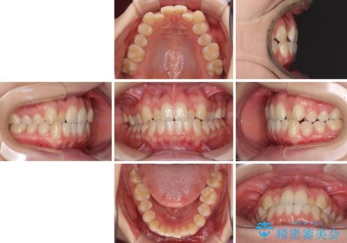 前歯のクロスバイトをインビザライン矯正で改善の治療前