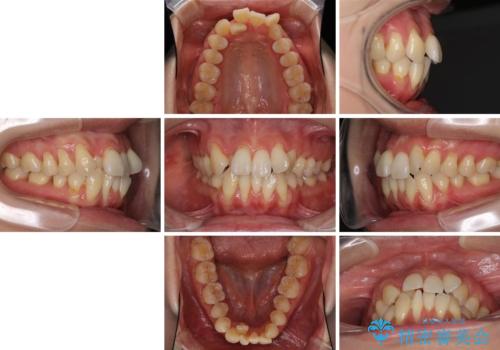 前歯のデコボコを治したい 費用を抑えた抜歯矯正の治療前