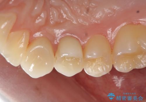 虫歯で歯が折れた セラミック審美修復の治療後