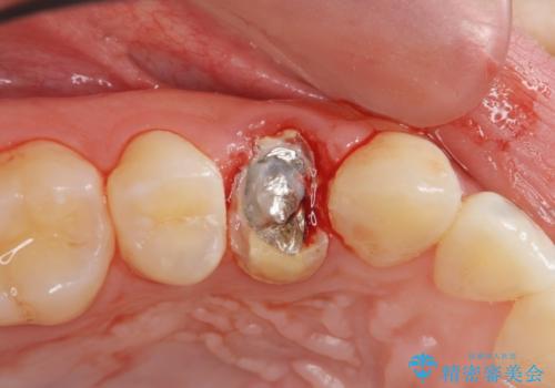 虫歯で歯が折れた セラミック審美修復の治療前