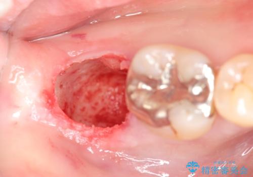 抜歯時歯槽堤保存術を用いた骨造成・インプラント治療の治療前