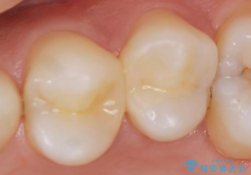 X線撮影によりわかる、内在する虫歯治療の症例 治療後