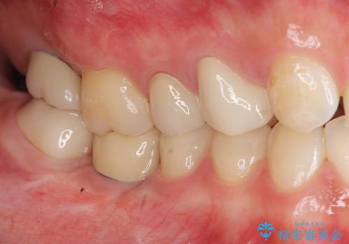 インプラントを用いた臼歯部欠損補綴の治療後