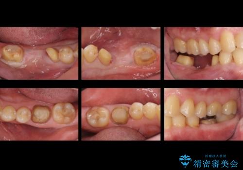 50代男性 受け口 他院で5年以上かかると治療を断られたの治療中