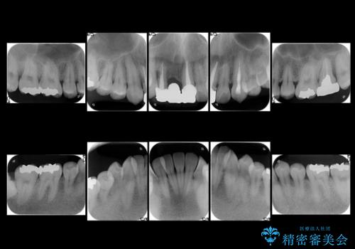 前歯ブリッジのやりかえ　下の歯のがたつき　銀歯を全てセラミックにの治療前