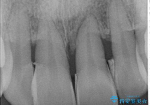 侵襲性歯周炎。前歯の歯周補綴の治療前