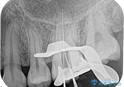 奥歯が痛い。根管治療の治療前