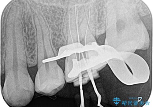 奥歯が痛い。根管治療の治療前