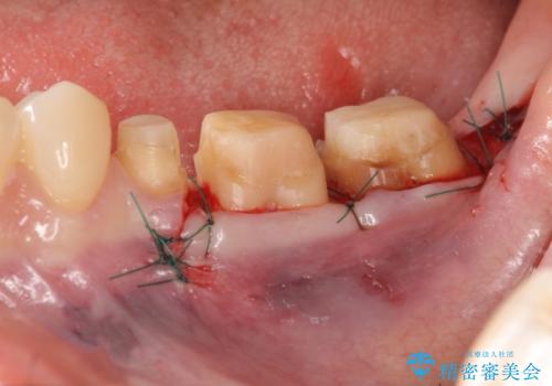歯ぐきからの出血 歯周外科による改善の治療中