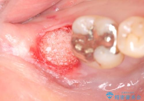 抜歯時歯槽堤保存術を用いた骨造成・インプラント治療の治療前