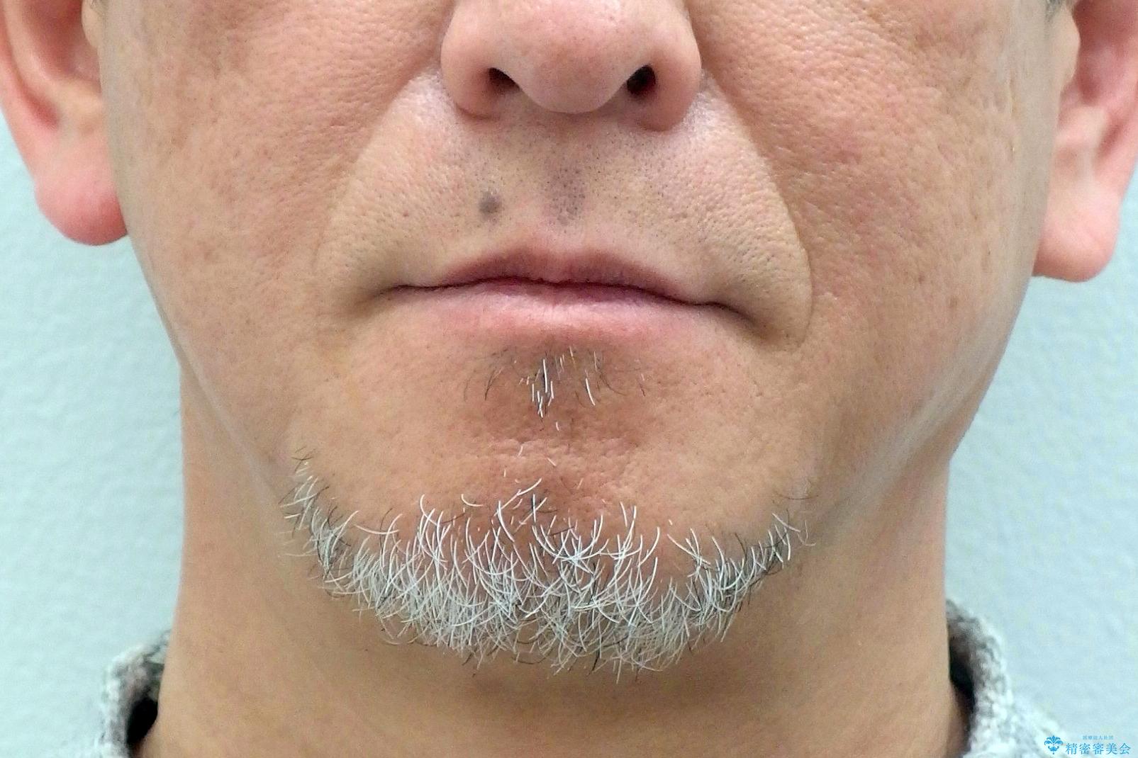 50代男性 受け口 他院で5年以上かかると治療を断られたの治療前(顔貌)