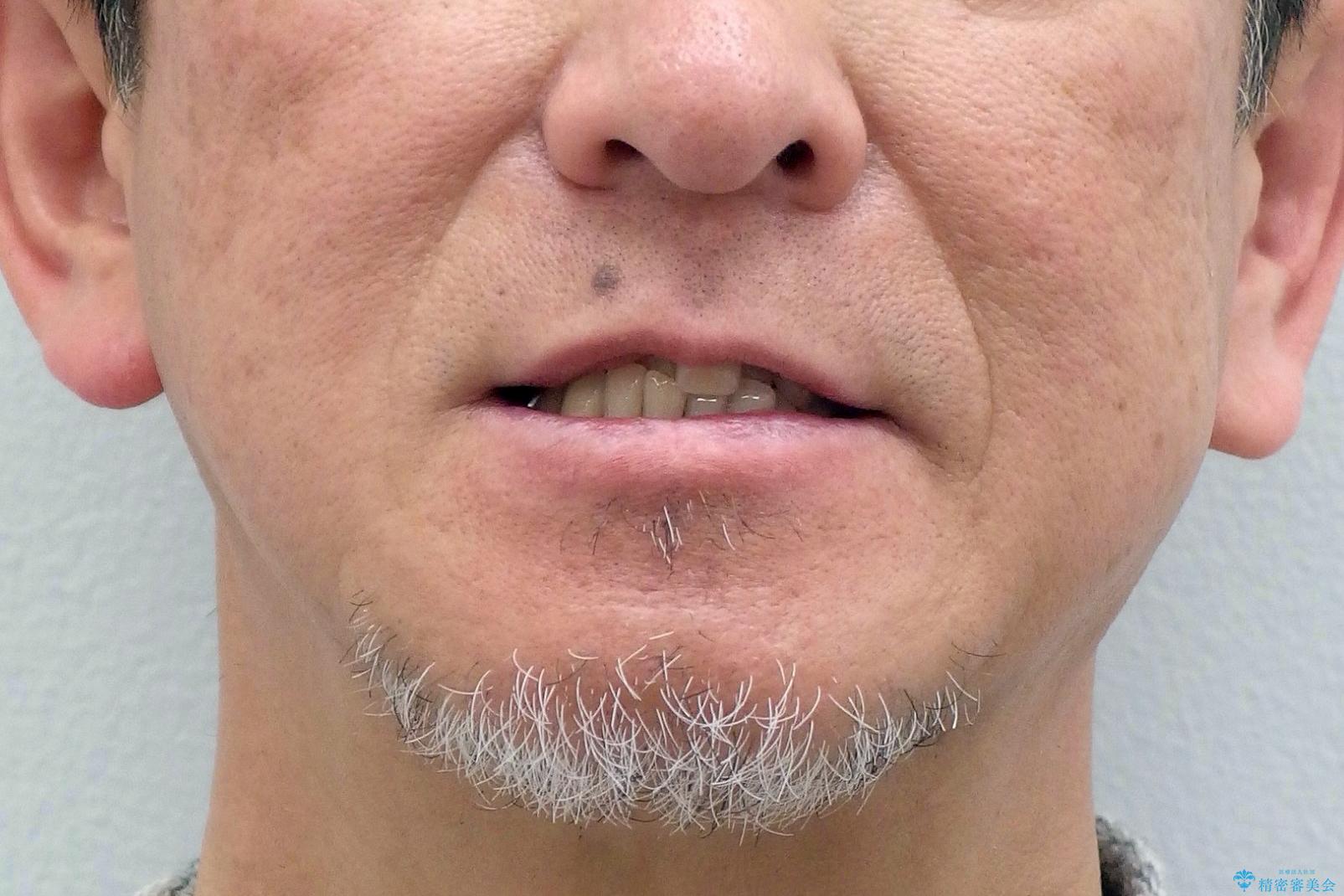 50代男性 受け口 他院で5年以上かかると治療を断られたの治療前(顔貌)