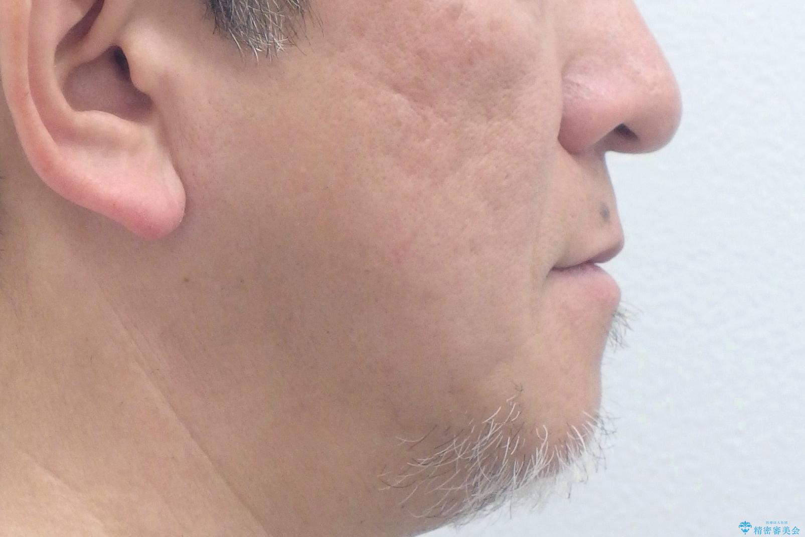 50代男性　受け口　他院で5年以上かかると治療を断られたの治療前（顔貌）