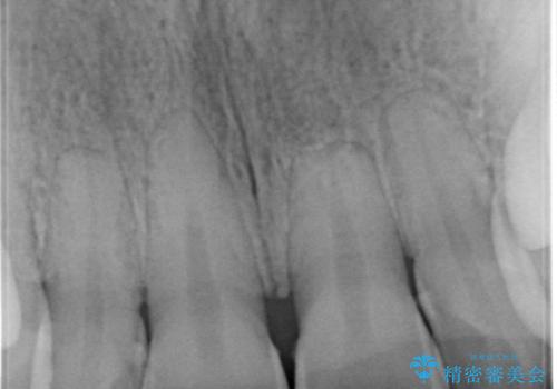 歯を白くしたい‐ウォーキングブリーチで内側から白くの治療前