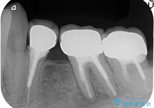 オールセラミッククラウン 痛くて咬めない奥歯の治療の治療前