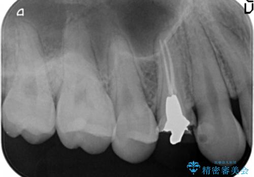 虫歯で歯が折れた セラミック審美修復の治療前