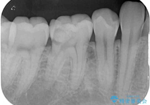 神経近くにまで及んだ大きなむし歯のセラミッククラウンの治療前
