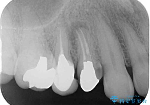 治療途中で放置していた歯 オールセラミッククラウンによる補綴治療の治療前