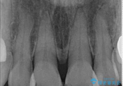 度重なる治療で前歯がしみる オールセラミッククラウンによる補綴治療の治療前