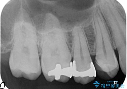 以前治療した歯が痛む　銀歯をセラミックにの治療前