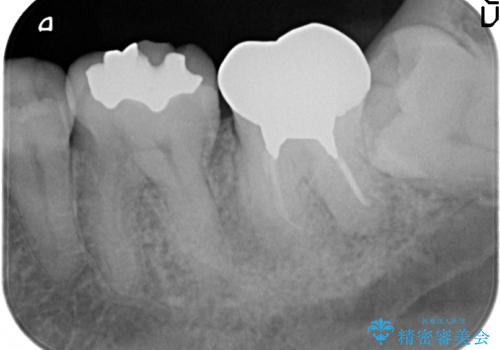 オールセラミッククラウン 咬むと痛む奥歯の治療