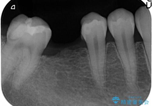 インプラントを用いた臼歯部欠損補綴の治療前
