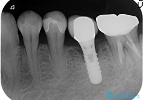 セラミックインレー 気になる銀歯を白くの治療後