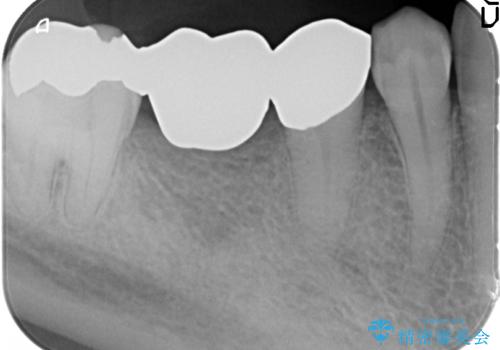 50代男性 受け口 他院で5年以上かかると治療を断られたの治療前