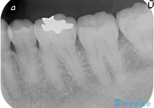 セラミックインレー しみる奥歯の治療の治療前