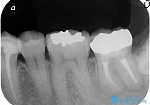 オールセラミッククラウン 咬むと痛む奥歯の治療の治療後