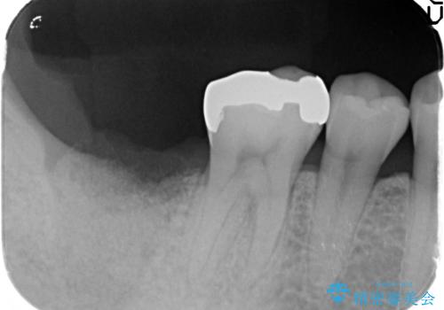 抜歯時歯槽堤保存術を用いた骨造成・インプラント治療の治療前