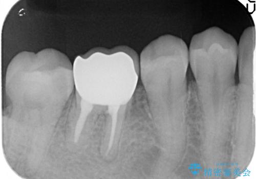 オールセラミッククラウン 鈍い痛みが続く奥歯の治療の治療後