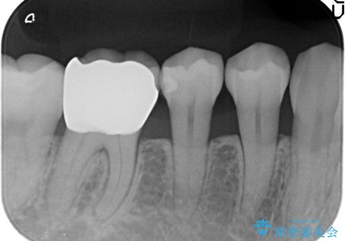 オールセラミッククラウン　目立つ銀歯を白い歯への治療後